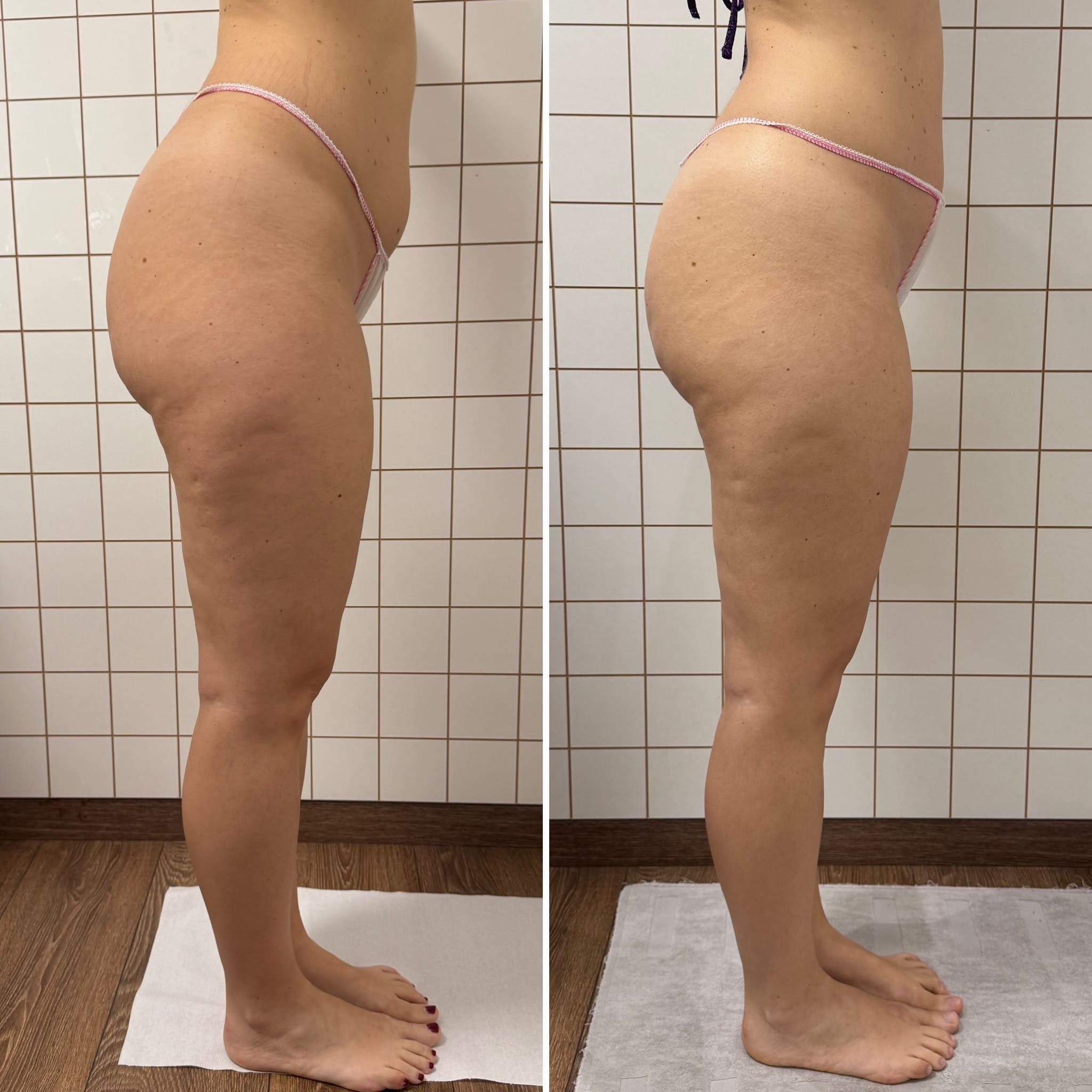 Risultato trattamento Body [R]Evolution — prima e dopo
