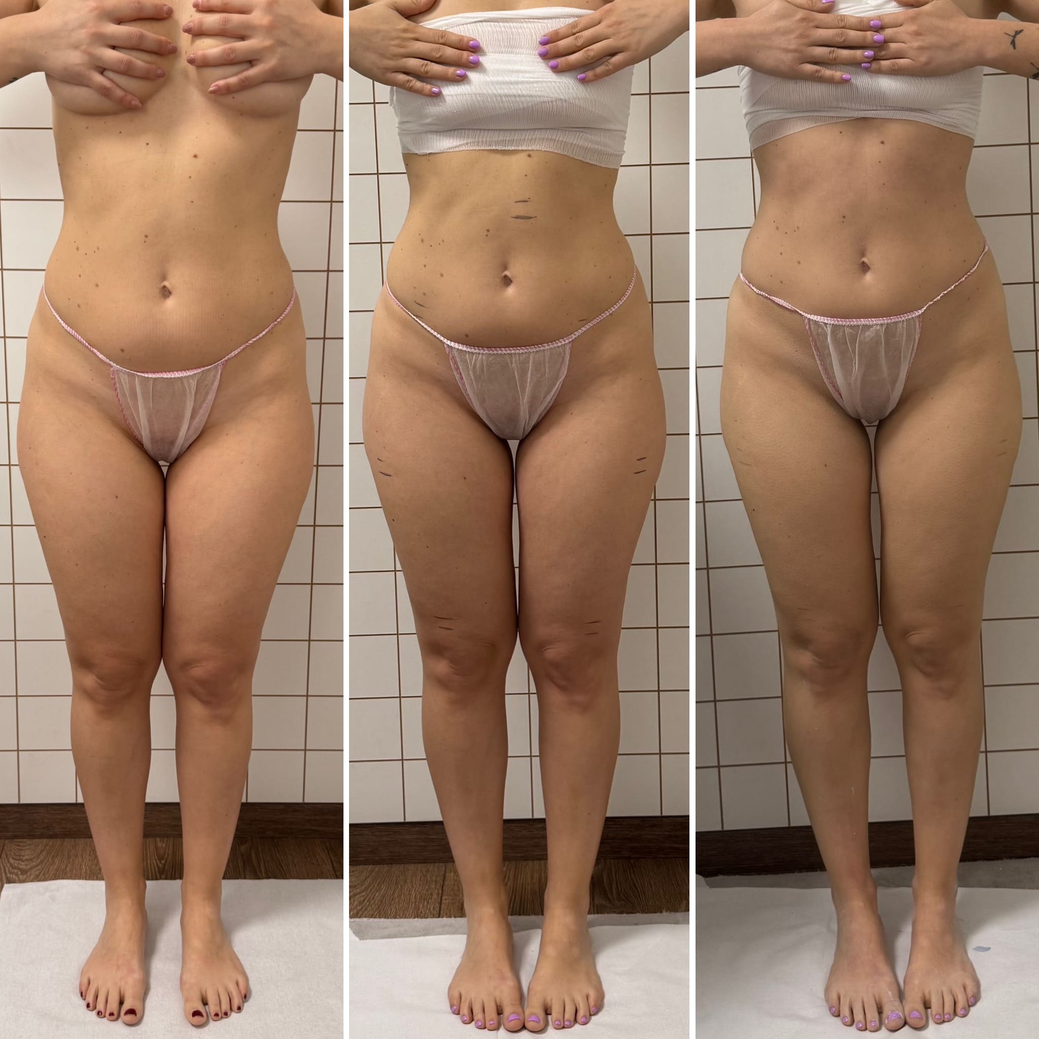 Risultato trattamento Body [R]Evolution — prima e dopo